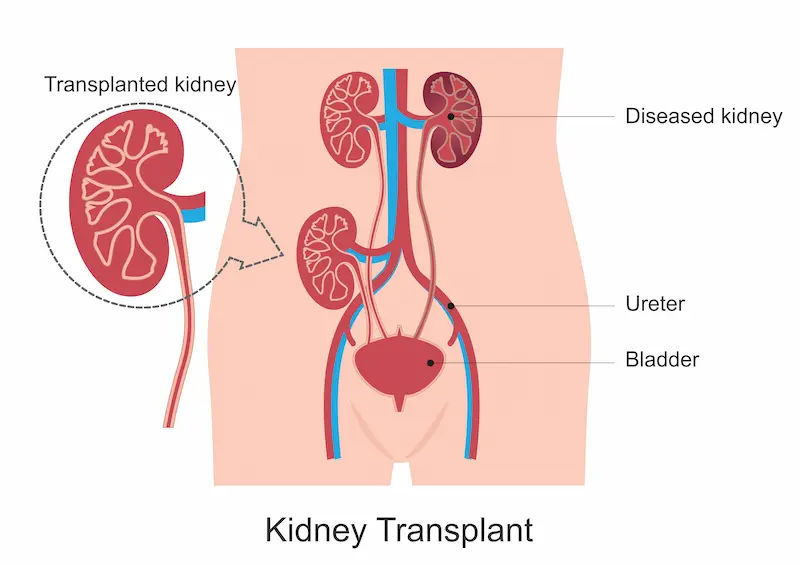 Guide to Kidney Transplant Recovery